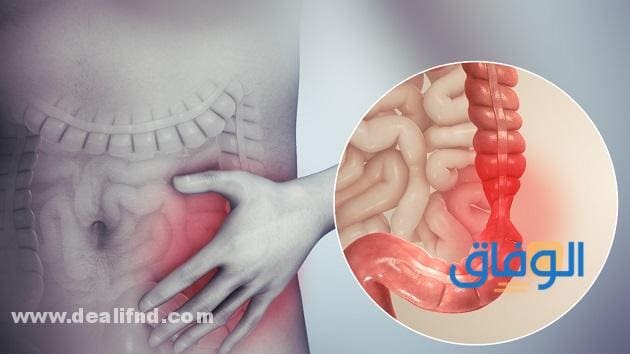أعراض غازات القولون وعلاجها بـ 06 طرق مجربة