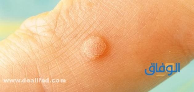 علاج عين السمكة