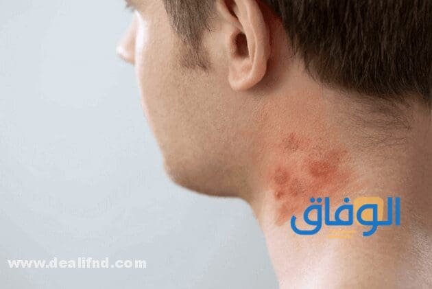 كريم اليكاسال Elicasal | دواعي الاستعمال والاثار الجانبية تجارب كريم اليكاسال