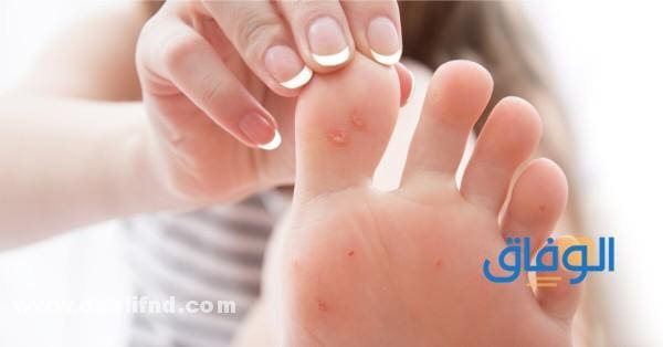 كيف أزيل مسمار القدم؟ و04 طرق طبيعية مزهلة لعلاجه