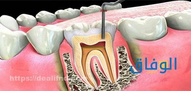 علاج التهاب عصب الأسنان | +06 طرق طبيعي