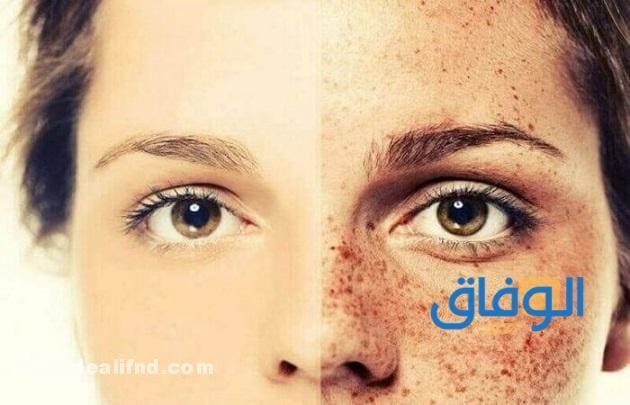 تجربتي في إزالة النمش؟ فعاالة 100% بالتفصيل !!