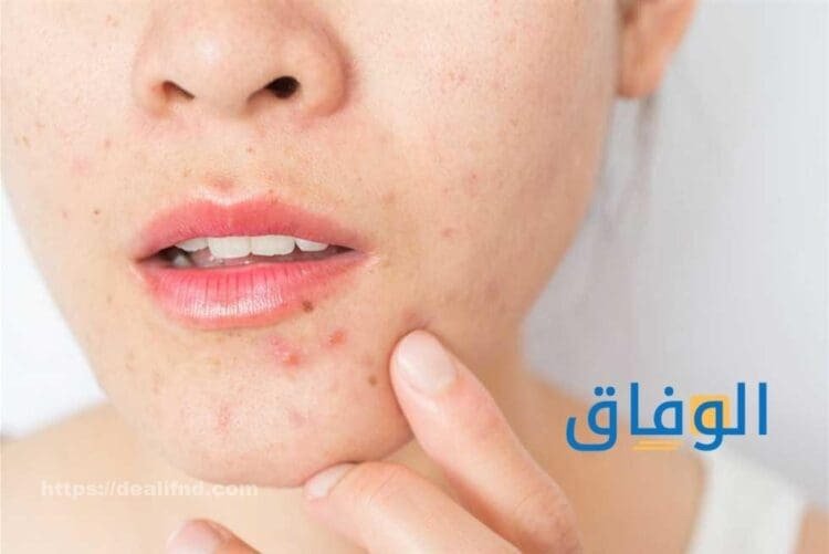 أسباب حبوب الذقن | وطرق علاج حبوب الذقن تحت الجلد؟