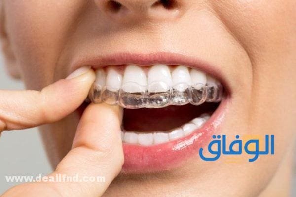 اسعار تقويم الأسنان في مصر 2024 ؟ باختلاف الحالات اسعار تقويم الأسنان في مصر 2023