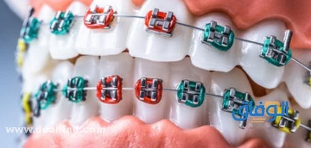 اسعار تقويم الأسنان في مصر 2024 ؟ باختلاف الحالات اسعار تقويم الأسنان في مصر 2023