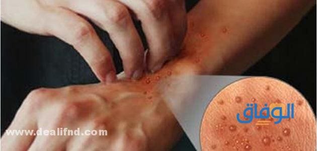 الفرق بين الجرب والحساسية