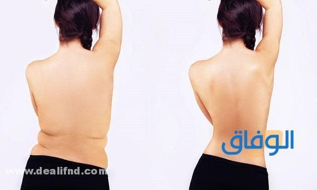 دهون الظهر تجربتي