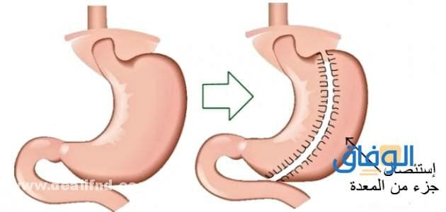 اسعار عملية التكميم – 4 أنواع مختلفة
