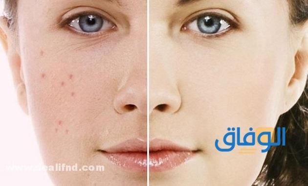 +05 علاج التصبغات الجلدية العميقة عن تجربة !! علاج التصبغات الجلدية العميقة.