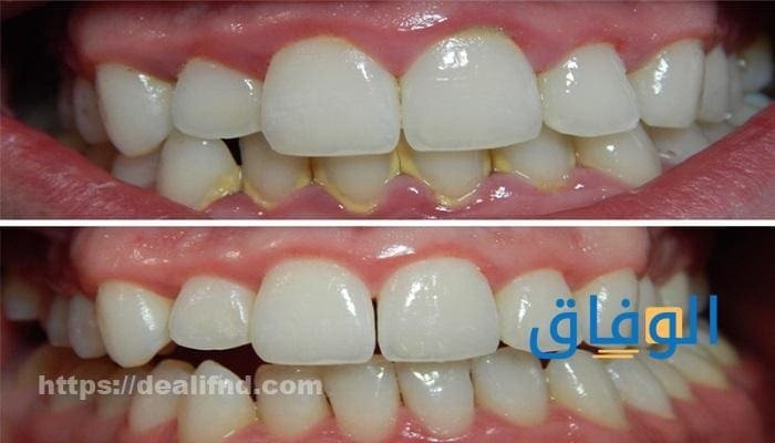 الجير في الأسنان 03 أسباب لظهور جير الأسنان كيف تتخلص من الجير في الأسنان؟