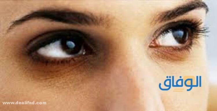 أسباب الهالات السوداء