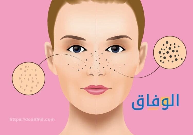 الرؤوس السوداء للبشرة 15 طريقة للحصول على بشرة صافية الرؤوس السوداء للبشرة