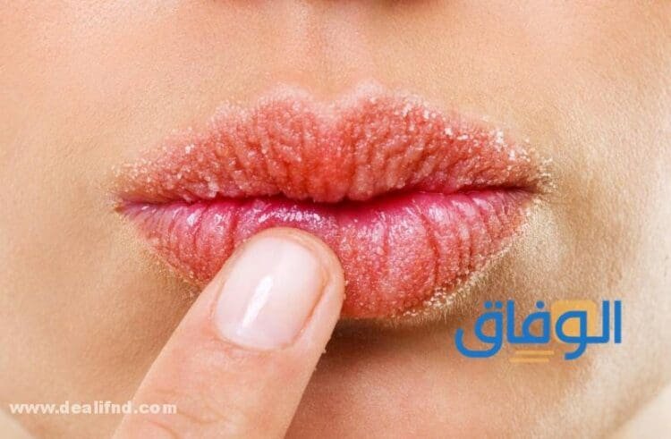 أسباب جفاف الشفايف: تعرف على الأسباب والطرق للوقاية