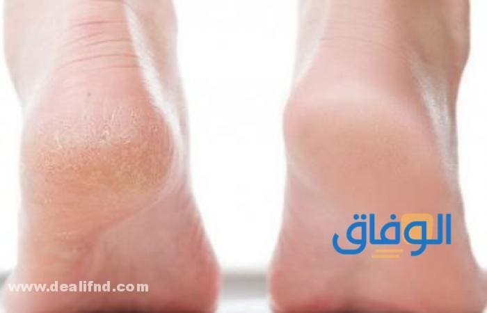 أسباب تشقق القدمين