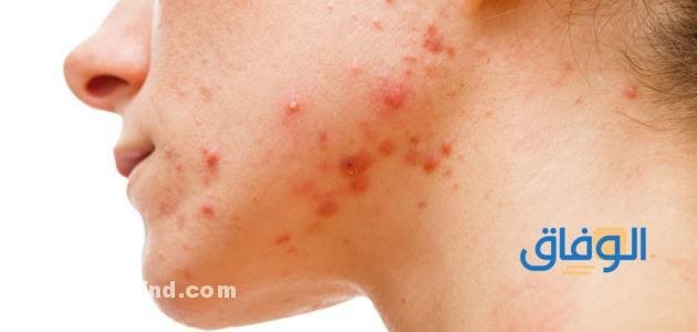 حبوب الذقن (طرق علاجها + نصائح هامة)