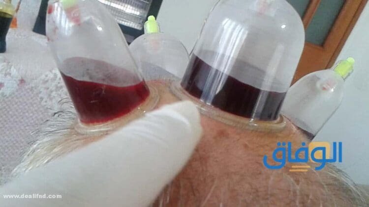 تجربتي مع حجامة الرأس