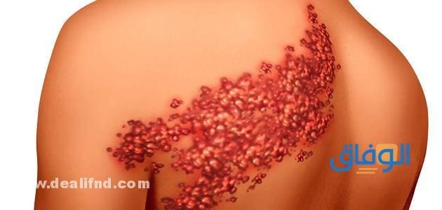 علاج الحزام الناري