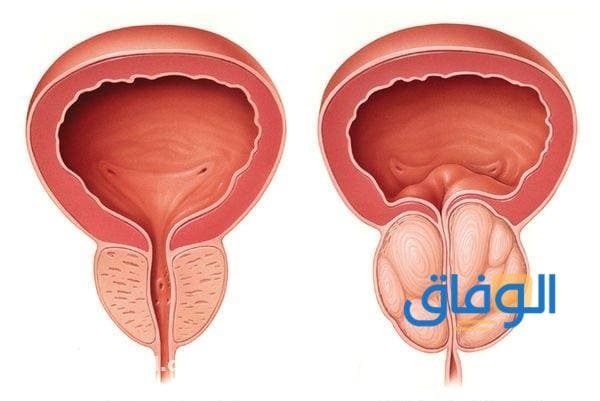 أعراض سرطان البروستاتا أعراض سرطان البروستاتا
