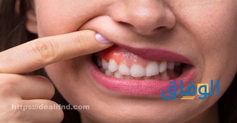 علاج التهاب اللثة بالمرة