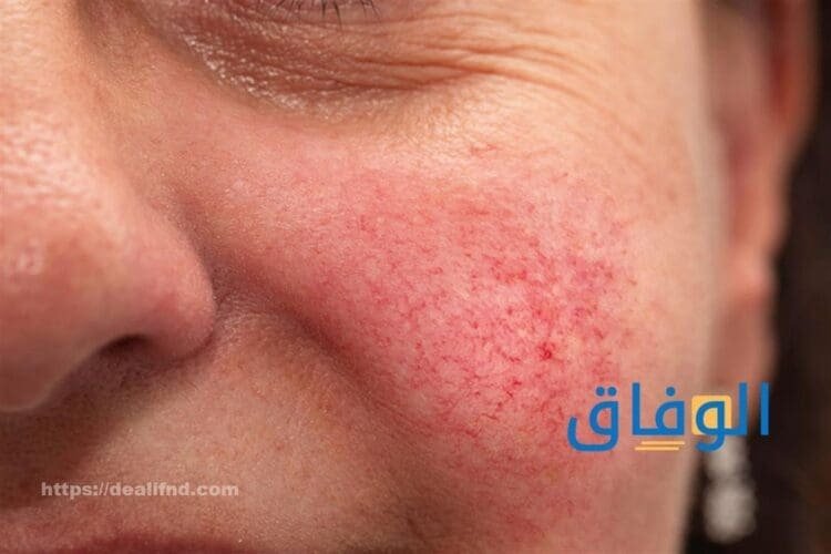 علاج وردية الوجه نهائياً 05 طرق للتخلص من النخالة الورية علاج وردية الوجه نهائيا
