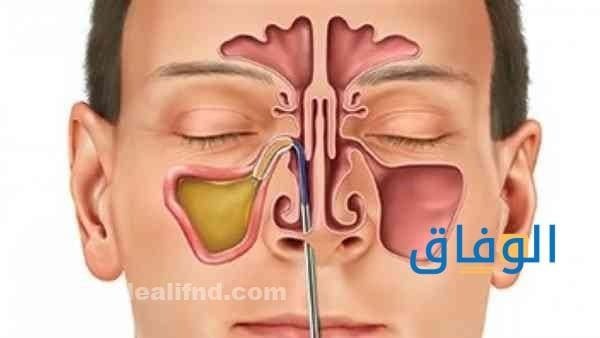 علاج نهائي للجيوب الأنفية أقوى 6 طرق للتخلص من حساسية الجيوب الأنفية علاج نهائي للجيوب الأنفية