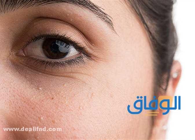 علاج حبوب تحت الجلد علاج حبوب تحت الجلد