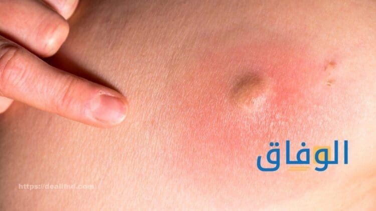 علاج الدمل بالمرة أكثر من 06 مكونات طبيعية للتخلص من الدمامل
