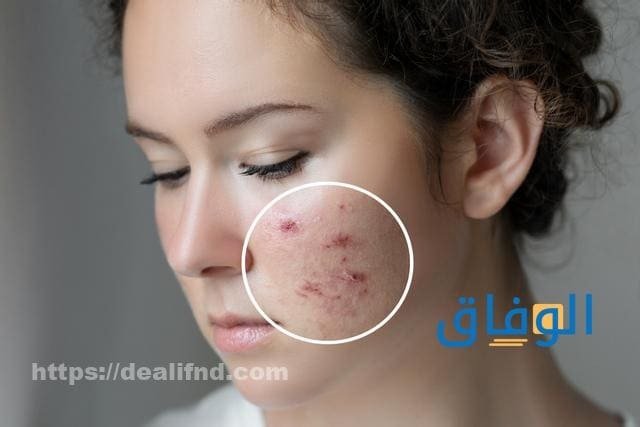 إزالة أثار الحبوب 07 طرق للقضاء على حب الشباب