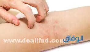 لعلاج الإكزيما نهائيا لعلاج الإكزيما نهائيا
