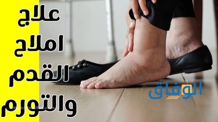 علاج الأملاح في القدم | أكثر من 15 نصيحة لتجنب ألم القدم علاج الأملاح في القدم