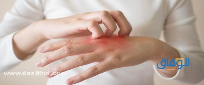 لعلاج الإكزيما نهائيا