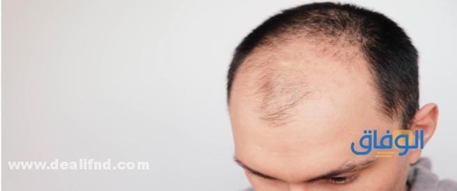 علاج الثعلبة من الصيدلية