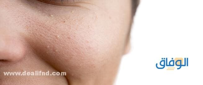 علاج حبوب تحت الجلد علاج حبوب تحت الجلد