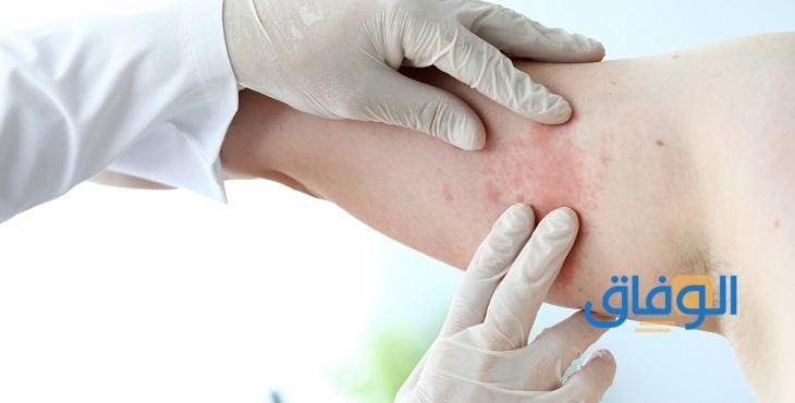 لعلاج الإكزيما نهائيا لعلاج الإكزيما نهائيا