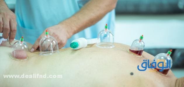 الحجامة واحتباس السوائل