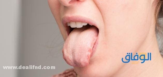 لون اللسان الطبيعي