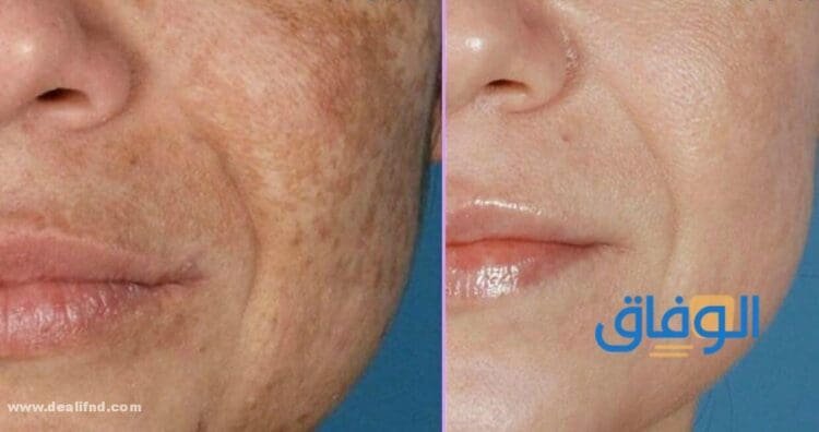 علاج تصبغات الوجه: طرق فعالة ونتائج سريعة