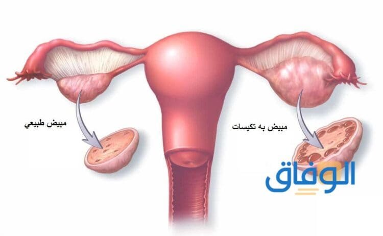 03 تجارب تكيس المبايض والحمل