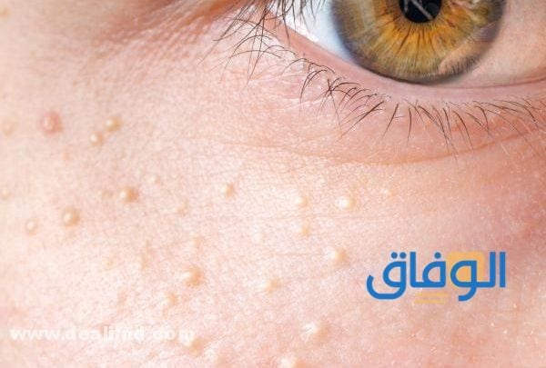 علاج حبوب تحت الجلد علاج حبوب تحت الجلد