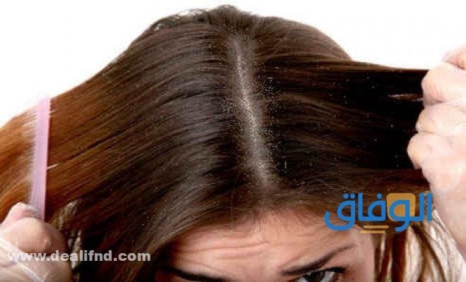 تقشير فروة الرأس