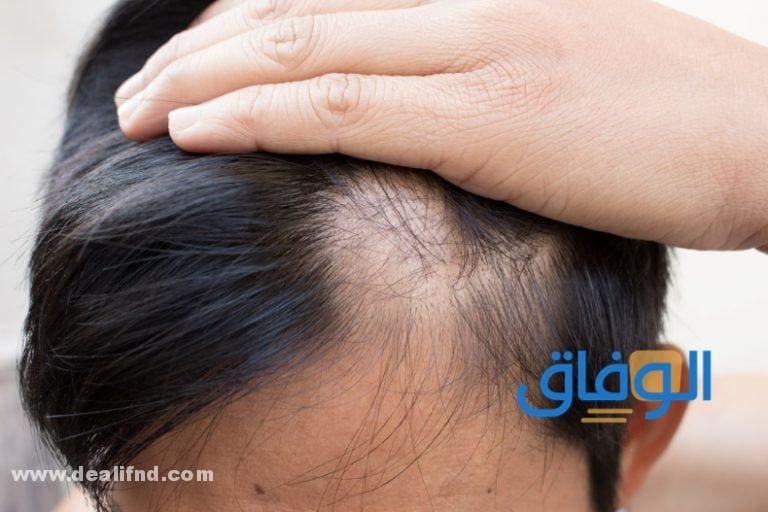 علاج الثعلبة من الصيدلية | افضل فيتامين لعلاج الثعلبة علاج الثعلبة من الصيدلية