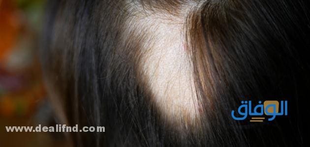 علاج الثعلبة من الصيدلية | افضل فيتامين لعلاج الثعلبة علاج الثعلبة من الصيدلية