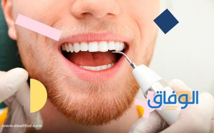 إزالة جير الأسنان تجربتي