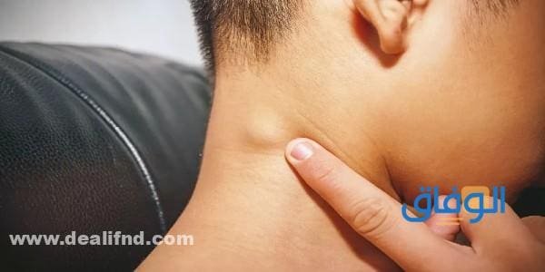 أماكن الغدد اللمفاوية | في الجسم وأسباب تضخمها