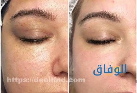 الديرمابن للوجه: الفوائد، الآثار الجانبية، والعناية بعد الجلسات كيف يكون الوجه بعد الديرمابن؟