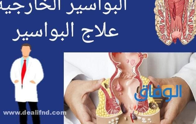 +07 أهم أعراض البواسير عند النساء | وما هي طرق العلاج أعراض البواسير الخارجية