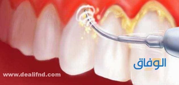 إزالة جير الأسنان تجربتي إزالة جير الأسنان تجربتي