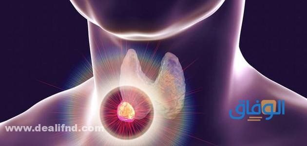 ما هي أسباب واعراض خمول الغدة الدرقية وطرق العلاج