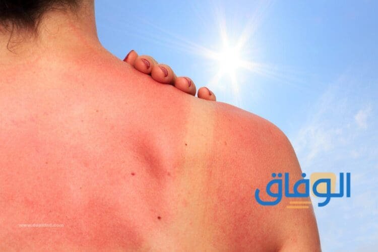 أفضل +05 كريمات لحروق الشمس | وأشهرهم فعالية