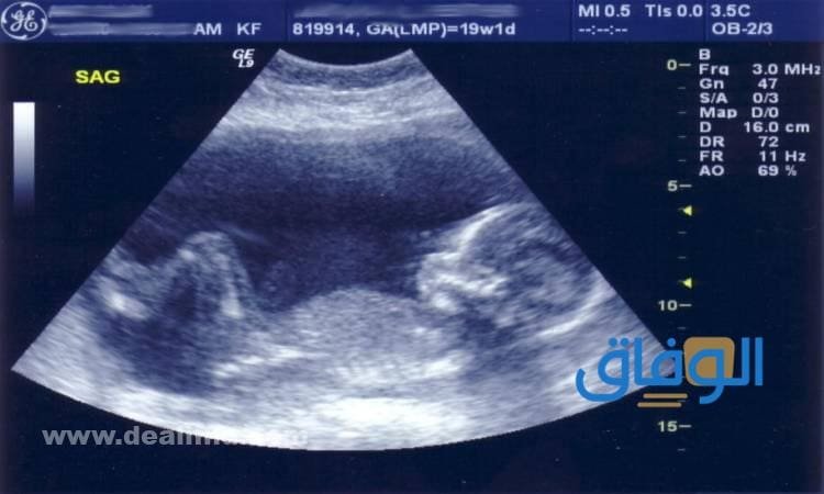 اختصارات السونار للحامل